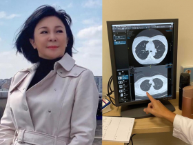 57歲吳淡如驚長20顆肺結節》除了追蹤還能做什麼？胸腔重症醫師：這樣做，4顆肺結節消失了